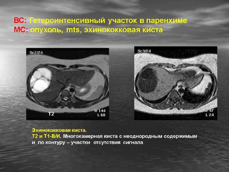 ВС: Гетероинтенсивный участок в паренхиме МС: опухоль, mts, эхинококковая киста Т2 Эхинококковая киста. 